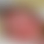 Hämangiom des Säuglings (Serie: 3 Monate alter Säugling). Ausgangsbefund eines großflächigen weni...