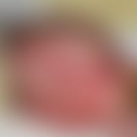 Haemangioma of the infant (series: 3-month-old infant); initial findings of a large hemangioma wi...