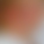 Hämangiom des Säuglings (Serie: 2Jahre alt, keine Therapie)
