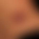 Hämangiom des Säuglings: gemischtes (intra-/subkutanes) Hämangiom
