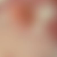 hemangioma, cavernous. a slightly acanthotic, orthokeratotic epithelium covers a sinusoidal cavit...