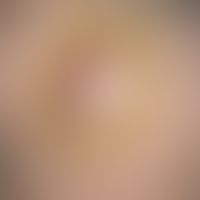 hematoma. painful stain after blunt trauma a week ago. blurred, peripherally tapering stain with ...