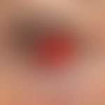 Hämatom. Akut aufgetretene Einblutung der Konjunktiven und Skleren bei einer 51-jährigen Patienti...