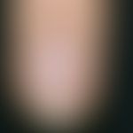 Chronic stationary, longitudinal reddish-brown stripes, localized in the nail plate, partly accom...