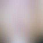 Harmless random finding of chronically stationary, longitudinal, localized in the nail plate, par...
