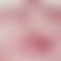 Analvenenthrombose, akute. Histologie. Ödematöser Knoten mit normalem Oberflächenepithel. Weitges...