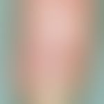 Half and half nails. zonal, slightly blurred white coloration of the proximal and brown coloratio...