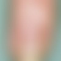 Half and half nails. zonal, slightly blurred white coloration of the proximal and brown coloratio...