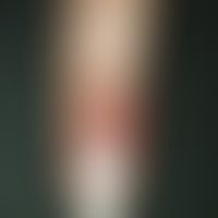 half and half nails. white coloration of the proximal half of the nail plate and sharply defined ...