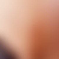 Neck fistula and cyst, lateral fistula opening with voiding at the anterior border of the sternoc...