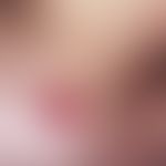Neck fistula and cyst, lateral. solitary, chronically in-patient, 2.5 x 1.5 cm in size, clearly i...