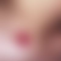Neck fistula and cyst, lateral. solitary, chronically in-patient, 2.5 x 1.5 cm in size, clearly i...