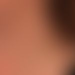 Neck fistula and cyst, lateral: skin-coloured nodule with a central porus from which a light-colo...