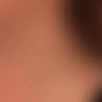 Neck fistula and cyst, lateral: skin-coloured nodule with a central porus from which a light-colo...