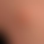Lateral neck fistula and cyst: detailed view

