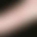 Hand-Fuß-Mund-Krankheit. Schmerzhafte entzündliche Bläschen im Bereich der Fingerbeugeseite.
