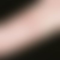 Hand-Fuß-Mund-Krankheit. Schmerzhafte entzündliche Bläschen im Bereich der Fingerbeugeseite.