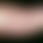 Hand-Fuß-Mund-Krankheit. Wenige, akute, disseminierte, schmerzhafte, schubweise aufschießende, po...