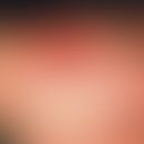 Handrückenödem, chronisch-traumatisches. Durch Scheuerreiz ausgelöstes Artefaktödem bei einer 17-...