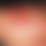 Edema of the back of the hand, chronic traumatic artifact edema caused by rubbing in a 17-year-ol...