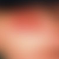 Handrückenödem, chronisch-traumatisches. Durch Scheuerreiz ausgelöstes Artefaktödem bei einer 17-...