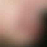 Skin metastasis: Solitary, very coarse, painless lump that grows within a few weeks; in this case...