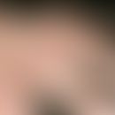 Heberdensche Arthrose. Knoten im Bereich der Mittelfingergelenke im Rahmen einer Polyarthrose. 86...
