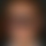 Parry-Romberg-Syndrom:&nbsp;Abb. 1 Ausgangsdokumentation der halbseitigen Gesichtsatrophie.
