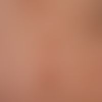 Pemphigoid gestationis. irregularly configured erythema and plaques with central blistering. part...