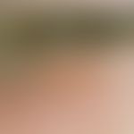 Herpes simplex virus infection; grouped, centrally navelled, partially eroded vesicles under the ...