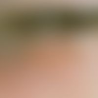 Herpes-simplex-Virus-Infektion. Gruppiert stehende, zentral genabelte, z.T. erodierte Bläschen un...