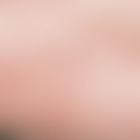 Herpes-simplex-Virus-Infektion:&nbsp; Inokulations-Herpes simplex. Ein derartiger&nbsp; Manifesta...