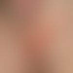 Herpes simplex virus infection: Solitary or grouped standing, 1-3 mm large, formerly tightened, b...