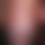 herpes simplex virus infection. typical clinical finding of genital herpes simplex. in a 30-year-...