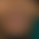 Herpes simplex virus infection: Extensive herpes simplex infection of the lower lip with pronounc...