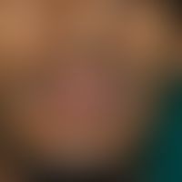 Herpes simplex virus infection: Extensive herpes simplex infection of the lower lip with pronounc...