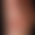 Herpes simplex virus infection: Inoculation herpes simplex, the site of manifestation (as well as...