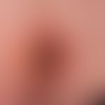 Herpes simplex virus infection: severe and extensive, very painful, feverish, perianal herpes sim...