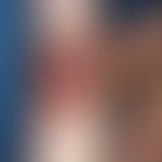 Herpes simplex recidivans:&nbsp;&nbsp;an dieser Lokalisation eher selten anzutreffende Herpes sim...