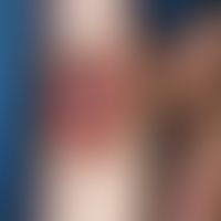 Herpes simplex recidivans:&nbsp;&nbsp;an dieser Lokalisation eher selten anzutreffende Herpes sim...