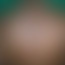 Herpes simplex zosteriformis Herpes simplex virus infection in a segmental arrangement in an HIV-...