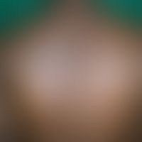 Herpes simplex zosteriformis. Herpes-simplex-Virus-Infektion in&nbsp;segmentaler&nbsp;Anordnung b...