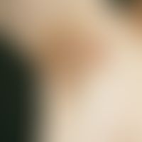 Hidradenitis suppurativa:&nbsp;chronisch-rezidivierende Entzündung mit schmerzenden Knoten und pl...