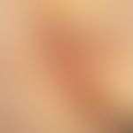 Hidradenitis suppurativa. chronic scarring stage, infiltrated intergrown strands and abscesses in...