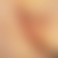 Hidradenitis suppurativa. chronic scarring stage, infiltrated intergrown strands and abscesses in...