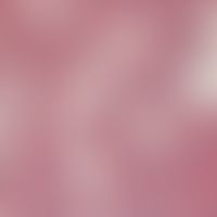 Hidradenitis suppurativa. Infiltration einer apokrinen Schweißdrüse durch neutrophile Granulozyten.