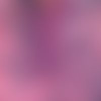 Hidradenitis suppurativa. Zystische, epitheliale Gangstruktur mit orthokeratotischem Material. Di...