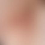 Hidradenitis suppurativa. chronic persistent brownish tinged rope ladder-like scarring in the lef...