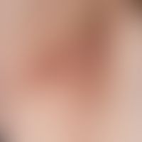 Hidradenitis suppurativa. Chronisch persistierende, bräunlich tingierte strickleiterartige Vernar...