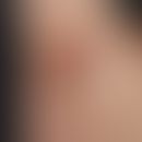 Hidradenitis suppurativa: chronically persistent, brownish or reddish livid scarring in the right...
